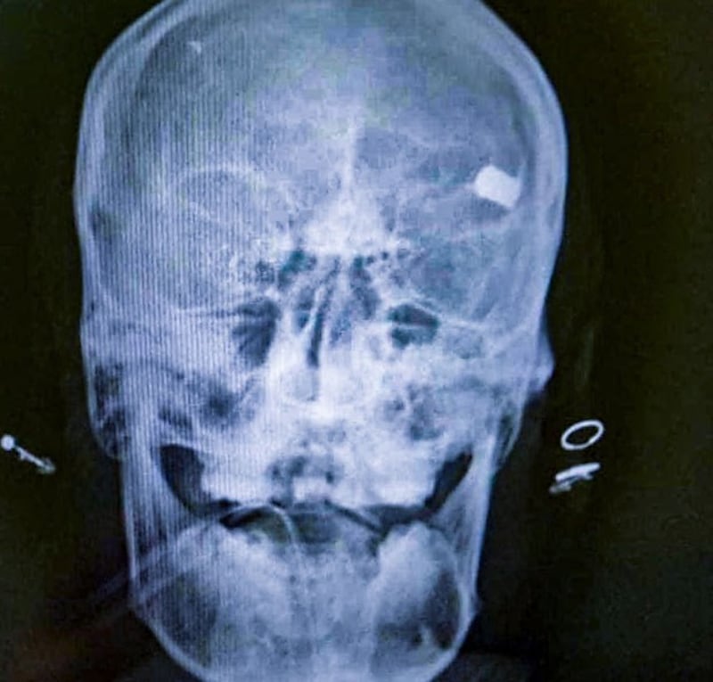 myanmar-xray-protester-skull-naypyidaw-feb9-2021.jpg