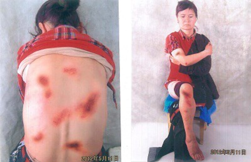 Uyghur petitioner Anargul Yusup took photos of her bruises after she was beaten by police on May 11, 2012. Credit: RFA.