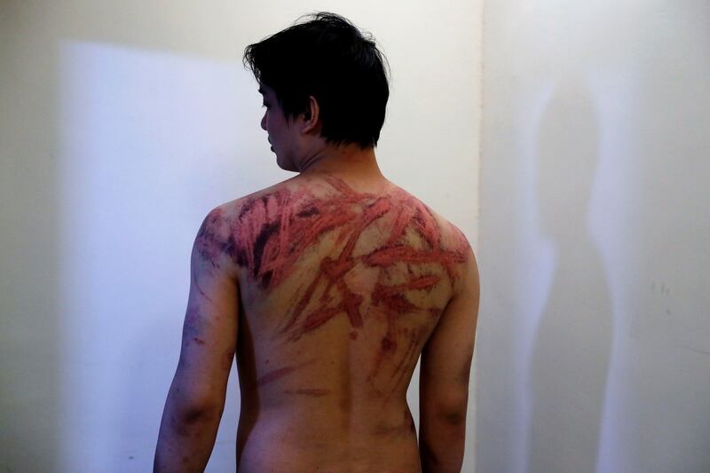 Calvin So, a victim of Sunday's Yuen Long attacks, shows his wounds at a hospital in Hong Kong, China July 22, 2019. Credit: Reuters