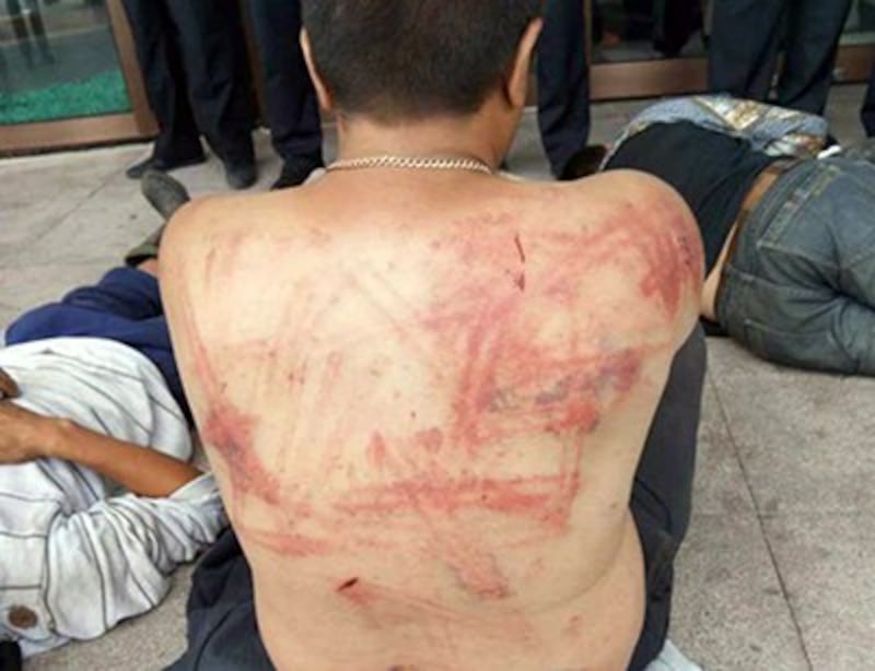 A herder displays injuries he says he sustained from police batons in Hulunbuir, Inner Mongolia, Aug. 4, 2017. Credit: Herders