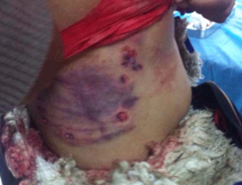 A Tibetan protester showing gunshot wounds in his abdomen.