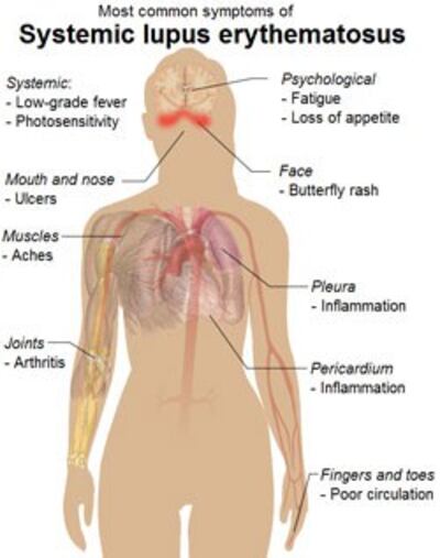 Những triệu chứng phổ biến của lupus ban đỏ hệ thống. Courtesy wikipedia.