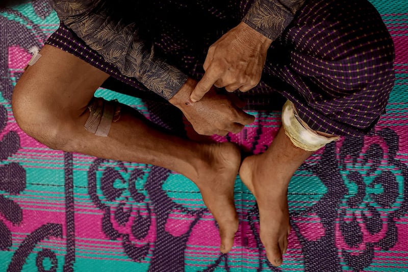 A Rohingya Muslim man who fled to Bangladesh from Maungdaw township in Myanmar shows his wounds after being injured in a drone attack on June 19, 2024. (Mohammad Ponir Hossain/Reuters)