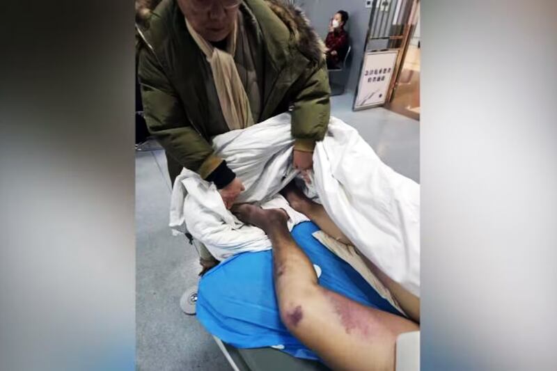 Bruises on the leg of ethnic Mongolian dissident Hada in undated photo.