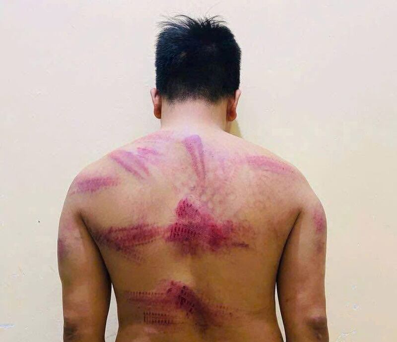 After his escape, Tu Anh Tu shows the bruises he received after being beaten at the scam center on Bokor Mountain in Cambodia.